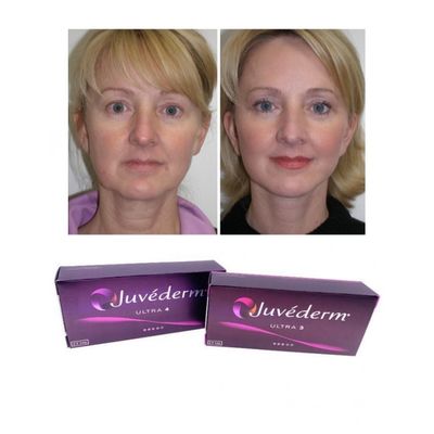 ระยะเวลา 6-9 เดือน Juvederm Dermal Filler Gel สําหรับการซื้อออนไลน์และในร้านค้า