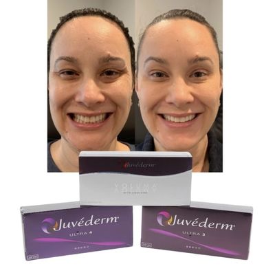 Juvederm Dermal Lip Fillers Hyaluronic Acid Cross Linked Injection การฉีดกรดไฮยอลูรอนิก