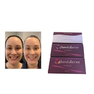 ยาฉีด Juvederm Voluma Cross Linked Dermal Filler ยาฉีด Juvederm Voluma ผิวหนังที่เชื่อมต่อกัน
