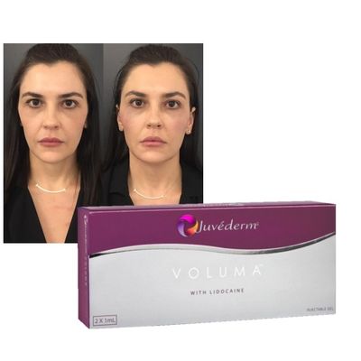ไฮยอลูรอนิกแอซิด เจลเติมผิวหนัง Juvederm ริมฝีปาก ใบหน้า การเยียวยา สูตรเสริม