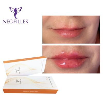 CE Hyaluronic Acid Cross Linked Dermal Filler For Lips Up 24mg/Ml