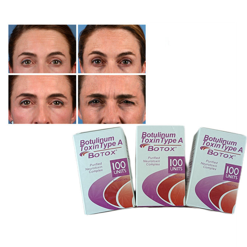 100U/ vial Botulinum Toxin ประเภท A ปูนโบโต๊กซ์ป้องกันริ้วรอย